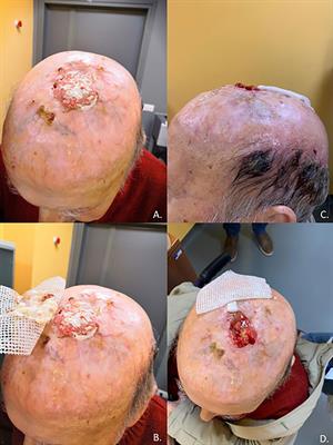 Immunotherapy for the Treatment of Cutaneous Squamous Cell Carcinoma